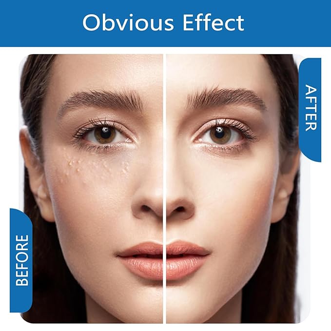 Milia Remover Treatment Serum, Milia Remover for Eyes & Face,Deep Clear to Get Glow Skin 0.85 oz