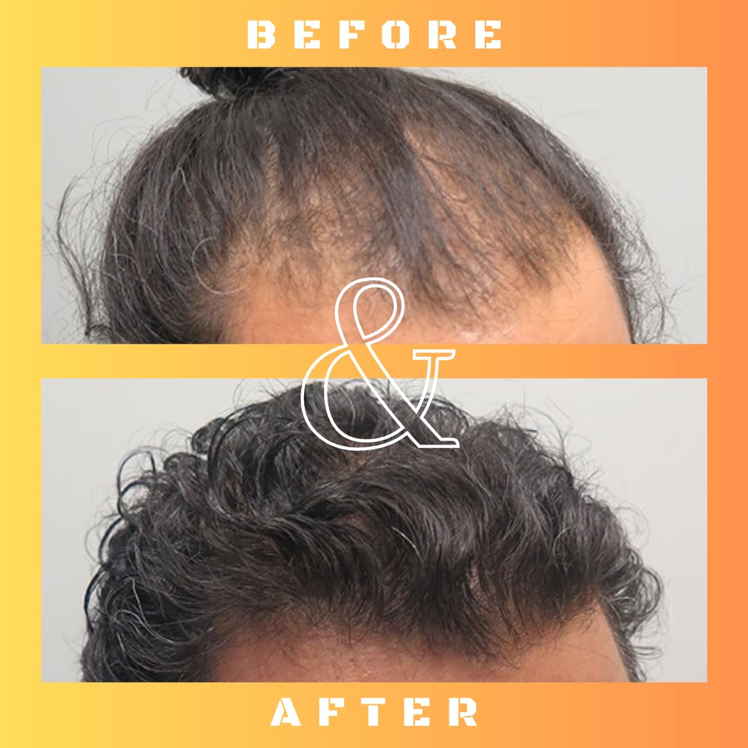 RU58841 5% Solution (50mg/ml) - DHT Blocker - Advanced Hair Loss Treatment - Anti-Androgen Hair Tonic - Promotes Hair Regrowth and Prevents Male Pattern Baldness - 30ml