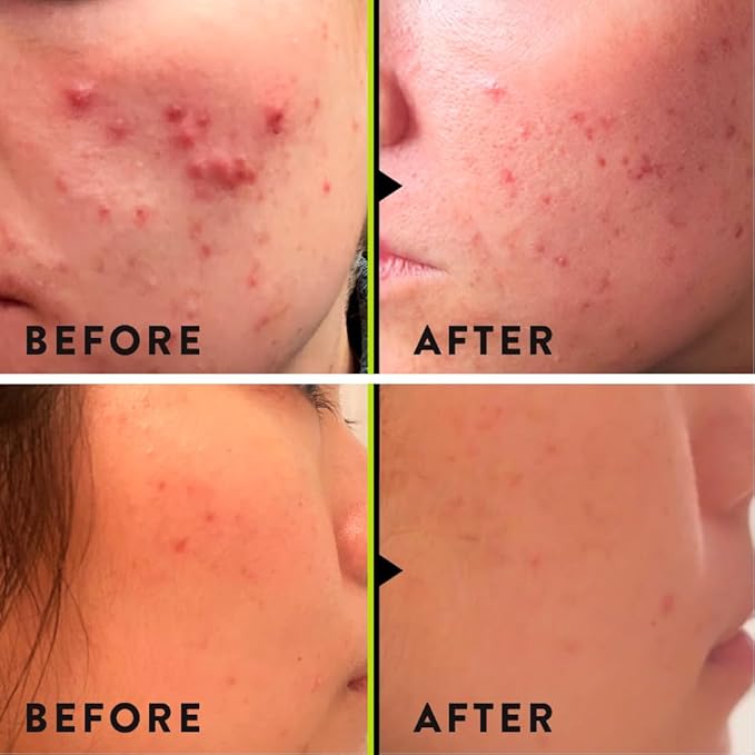 VERI Nitric Oxide + Salicylic Acid Clear Skin System (Peroxide-Free)- For Acne Prone Skin, Unclogs Pores, Clarifies Blemishes, Reduces Inflammation, Prevent Future Breakouts, 30 mL / 1 oz