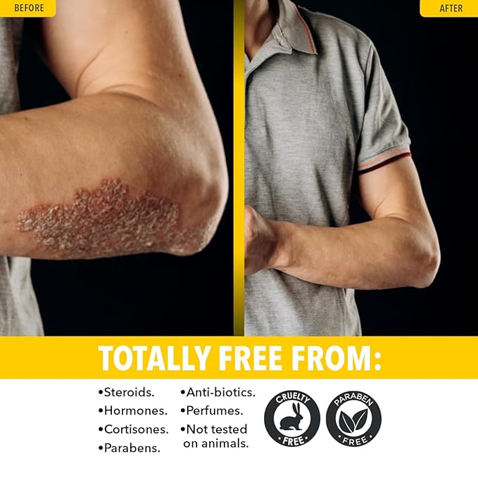 Dr. Robaina Sulfur Balsam Lotion – Daily Moisturizing Lotion for Eczema and Psoriasis Relief – Soothes Redness, Hydrates Sensitive Skin – Natural Ingredients – Made in the USA (Pack of 2)