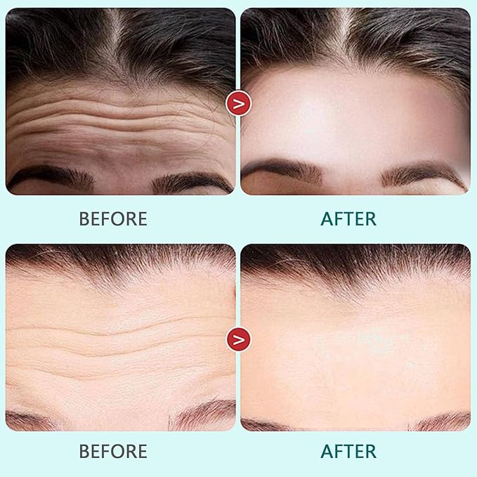 2PCS Reusable Forehead Wrinkle Patches Silicone Forehead Patches Anti-Wrinkle, Wrinkles Treatment for Wrinkles & Fine Lines, Non Invasive Reusable Wrinkle Smoothers