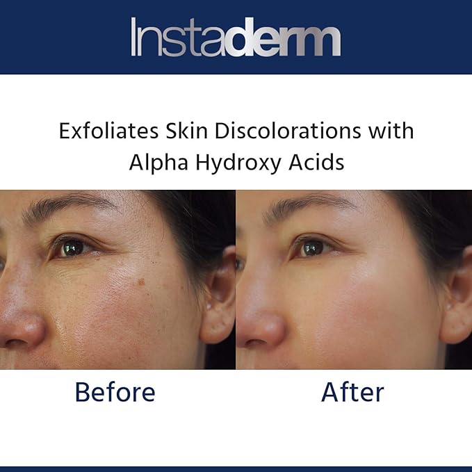 Glycolic Acid 15% Anti-Aging Cream- Alpha Hydroxy Facial Moisturizer Reduces the Appearance of Fine Lines, Wrinkles, Age Spots, Dark Spots & Scars. Exfoliates & Smoothes Skin Texture & Tone.