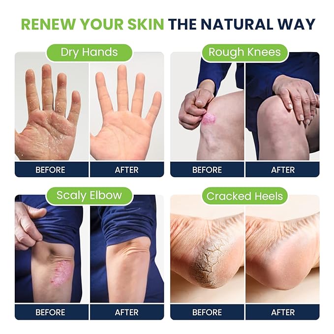 Tea Tree Oil Foot Cream - Moisturizing Athletes Foot Care For Dry Cracked Feet Cream - Heel & Callus Removal,& Tea Tree Foot Soak, Callus Remover Gel Foot File Pedicure Kit