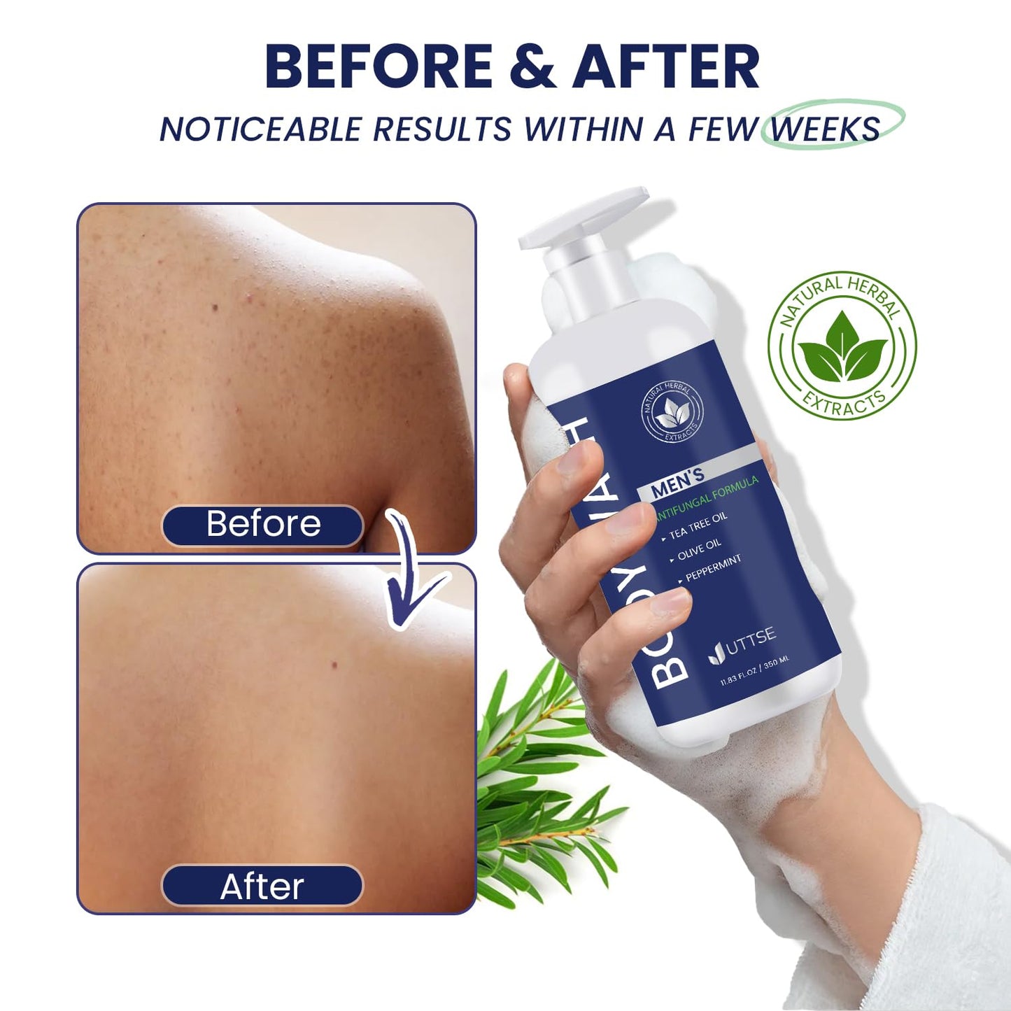 Tea Tree Body Wash: Antifungal Soap for Men - Eliminates Body Odors & Skin Irritations - 11.8fl oz/350mL