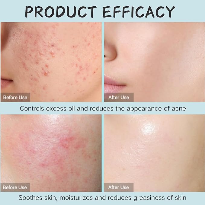 Tea Tree Salicylic Acid Skin Care Kit Teen Girl Gifts - 4 Pcs Skin Care Set Women Hydrating - Skin Care for Teens 10-12 - Acne Treatment for Face - Skincare Gift Set with Serum,Cream,Toner,Cleanser