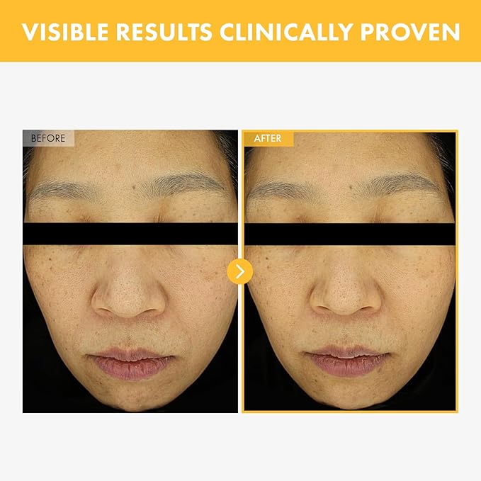 8 Days Spot Cream, Dark Spot Remover for Face, Age Spot, Sun Spot, Freckles, Melasma, Brown Spot Serum, Advanced Formula Corrector Cream with Niacinamide for Women and Men, 50g, 1.76 oz.