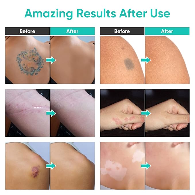 Tattoo Cover Up Makeup Waterproof, Sweatproof Concealer for Scars, Vitiligo, Dark Spots, Long-Lasting, Natural Finish for Body & Legs