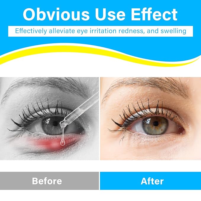 Stye Eye Treatment, Natural Stye Treatment Serum for Styes Chalazion and Blepharitis, Mild & Fast Relief