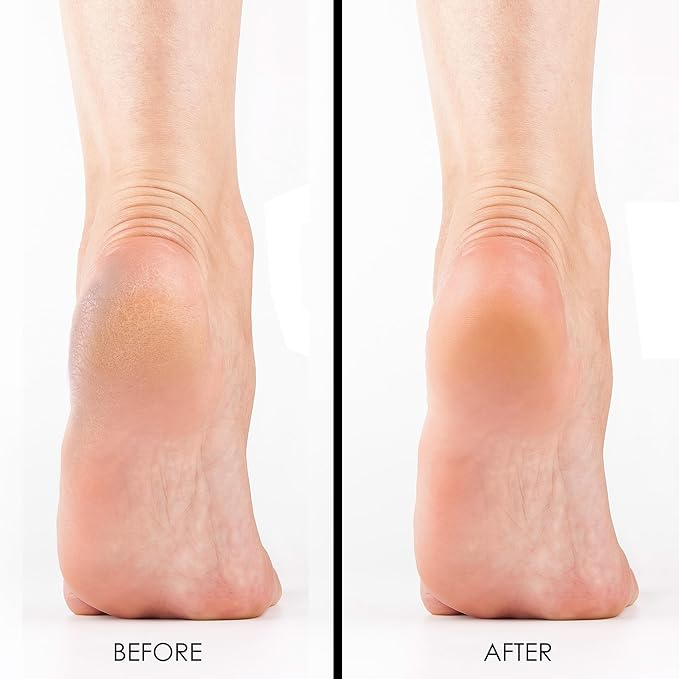 DeEnti Pumice Stones, Pack of 6 Professional Grade Pumice Stone for Feet, Salon Quality Foot Callus Remover, Double Sided Foot Scraper, Home Manicure and Pedicure Tools