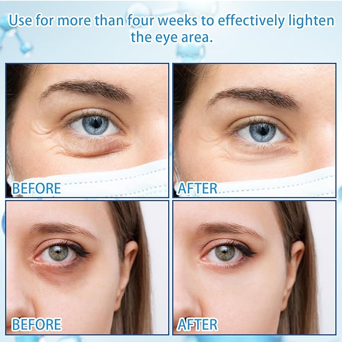 5% Caffeine Eye Serum with 360° Massage Rollerball Topper,Caffeine Cream for Dark Circles,Wrinkles,Puffiness and Fine Lines,Under Eye Roller Cream Treatment for Women and Men