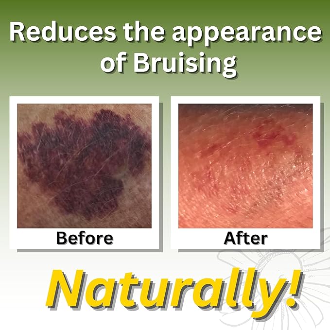 Relief Arnica Cream Natural Lotion for Effective Sore Muscle Relief | Arnica Bruise Cream with Lemongrass & Eucalyptus Essential Oils | Best Massage Lotion for Massage Therapy – 2 Pack