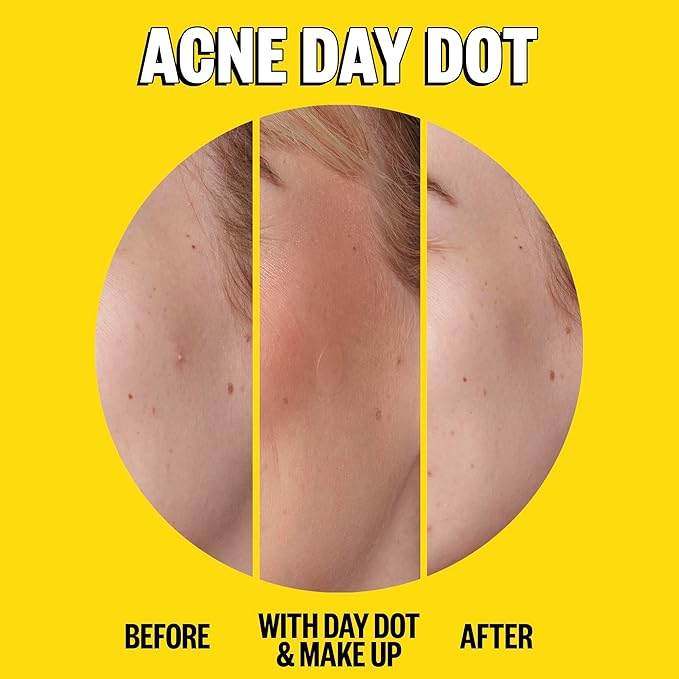 PEACE OUT Acne Day & Night Duo, Sheer Hydrocolloid Pimple Patches For Day Plus Overnight Acne Dots, Helps Clear Blemishes Quickly with Salicylic Acid, Retinol and Aloe Vera, 20 dots
