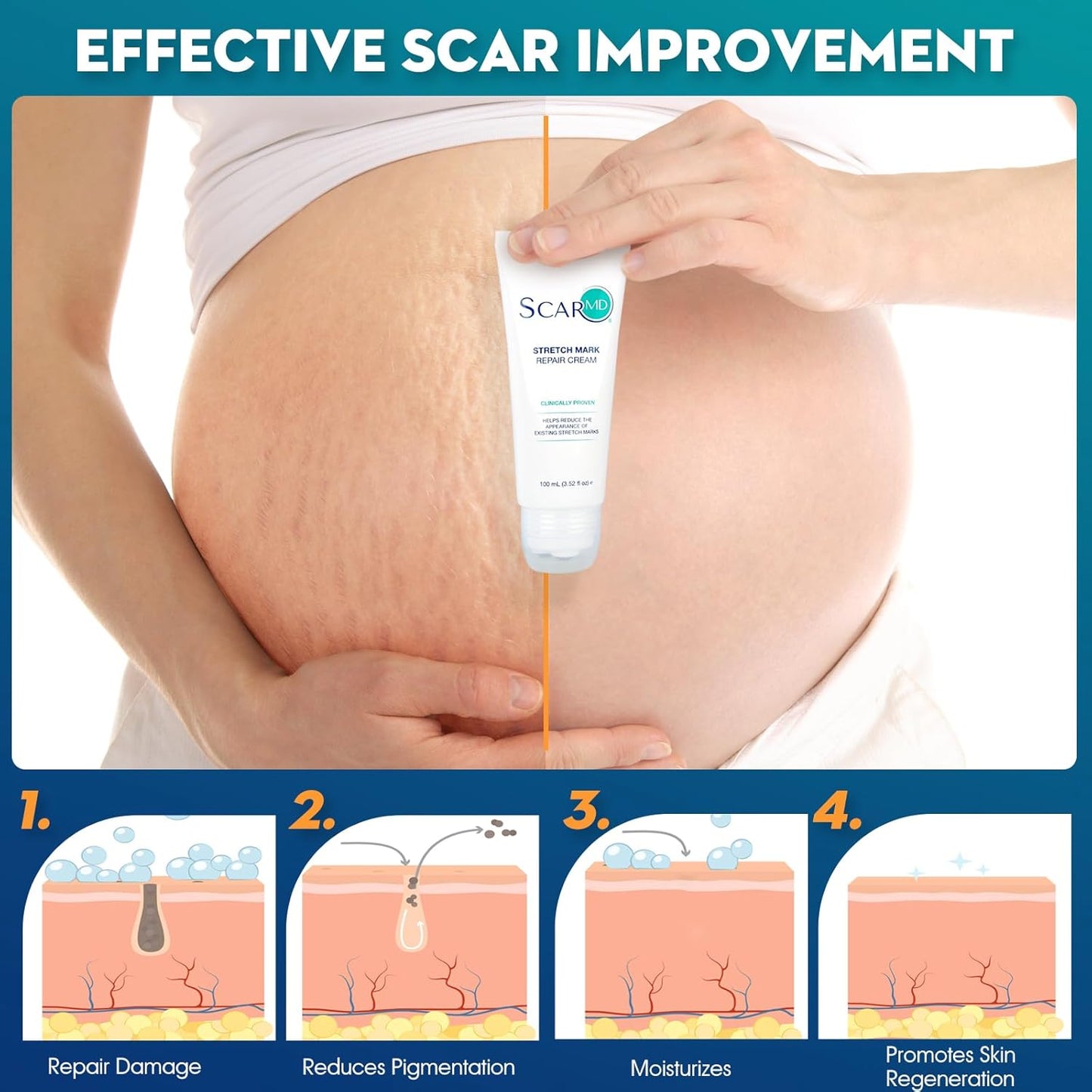 Stretch Mark Repair Cream is Formulated with Botanical Ingredients to Effectively Minimize Stretch Marks for a Smoother, More Even Skin Tone