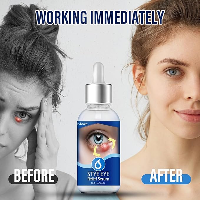 Stye Eye Treatment, Natural Stye Remover, Eye Stye Relief Serum, Premium Formula - Gentle Cleanser for Chalazion & Blepharitis (1 Fl Oz (Pack of 1))