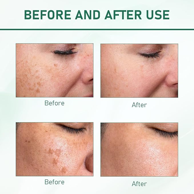 2Pcs Upgraded Anti-𝐟𝐫𝐞𝐜𝐤𝐥𝐞 Essence Oil, 577 𝐒𝐩𝐨𝐭 Remover Serum, Yuxintang Facial Spray, 577 Spray for Face, Body