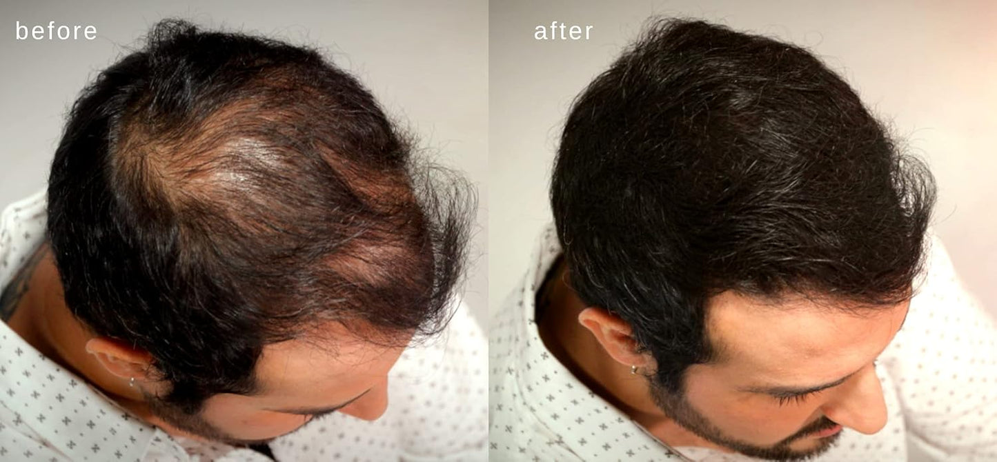 Hair Building Fibers - Volumizing Hair Fibers with real Keratin for Thinning Hair/Hair Loss Dermatologist Tested and Certified Hypoallergenic - 60 days + supply (Medium Brown)