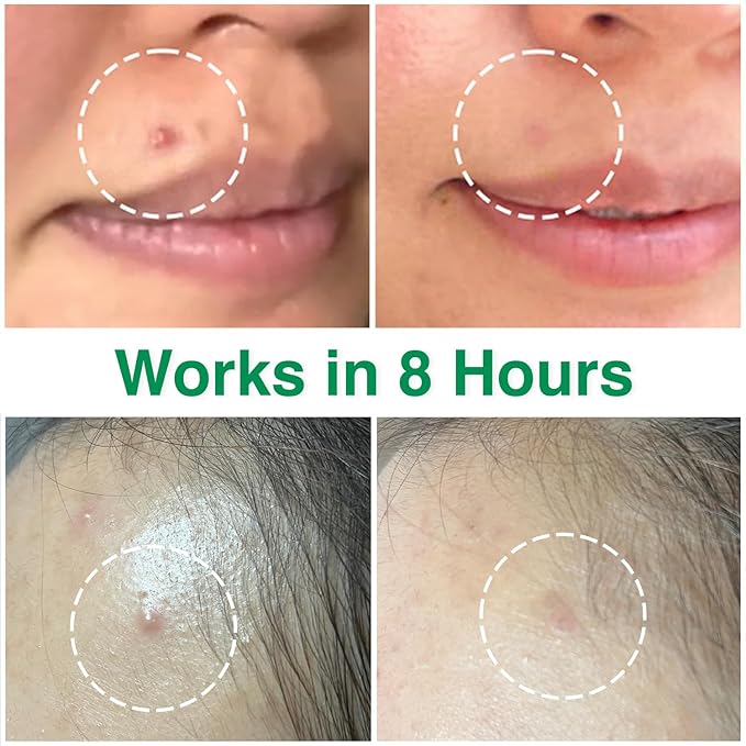 ACROPASS Acne Cure DEN Microarray Patch, OTC Salicylic Acid 2% (4ct) – Acne Treatment for Sensitive Skin, Anti-Inflammation