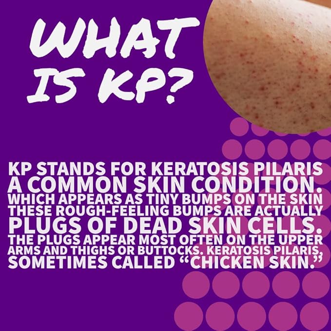 KP Keratosis Pilaris Treatment, KP Bump Eraser Hydrating lotion, Bumps Be Gone, Moisturizing and exfoliating lotion For Rough and Bumpy Dry Skin For Body, 8 Oz