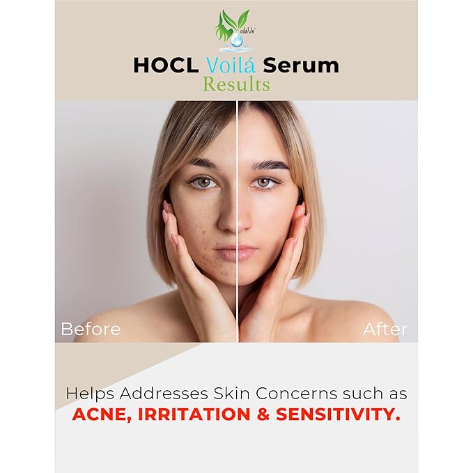 VoilaVe Pure Hypochlorous Acid Serum, Anti-Wrinkle Hypochlorous Acid Face Serum for Redness - Reduce Dryness, Skin Irritation, Eye Puffiness & Dark Circles | For Acne & Spots 2.0 Oz