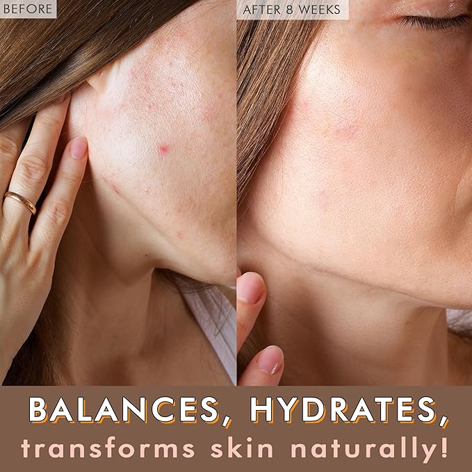 USDA Organic Face Oil - USA Made with Natural Ingredients, Anti Aging Formula for Acne-Prone & Oily Skin, Facial Oil with Vitamin E, Rosehip, Argan & Jojoba Oils for Sensitive Skin, Eczema & Rosacea