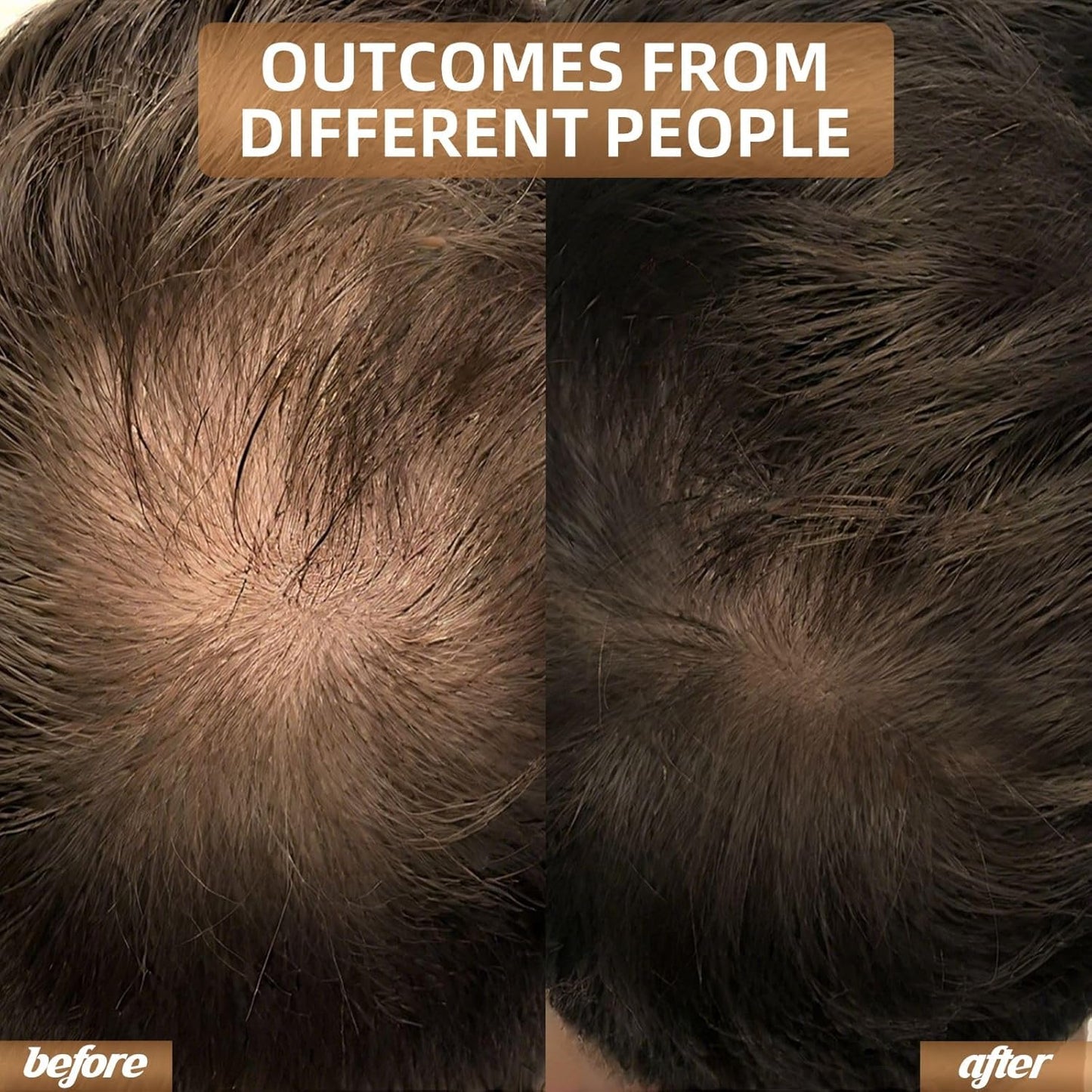 Red Light Therapy for Hair Growth, Laser Hair Loss Treatments Hat, Discreet Daily Use Under Hats, 20-min Rechargeable