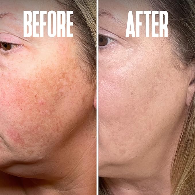 Save 14% on The Skin Care Solution For Dark Spots, Razor Bumps, Ingrown Hair & Razor Burns – Includes Our Ultra Potent Brightening + Razor Bumps Solution For an Ultra Clear & Glowing Skin