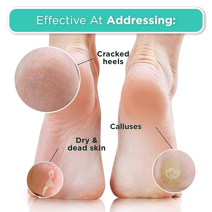 DERMORA Foot Peel Mask - 2 Pack of Large Size Skin Exfoliating Foot Masks for Dry, Cracked Feet, Callus, Dead Skin Remover - Feet Peeling Mask for baby soft feet, Vanilla Scent