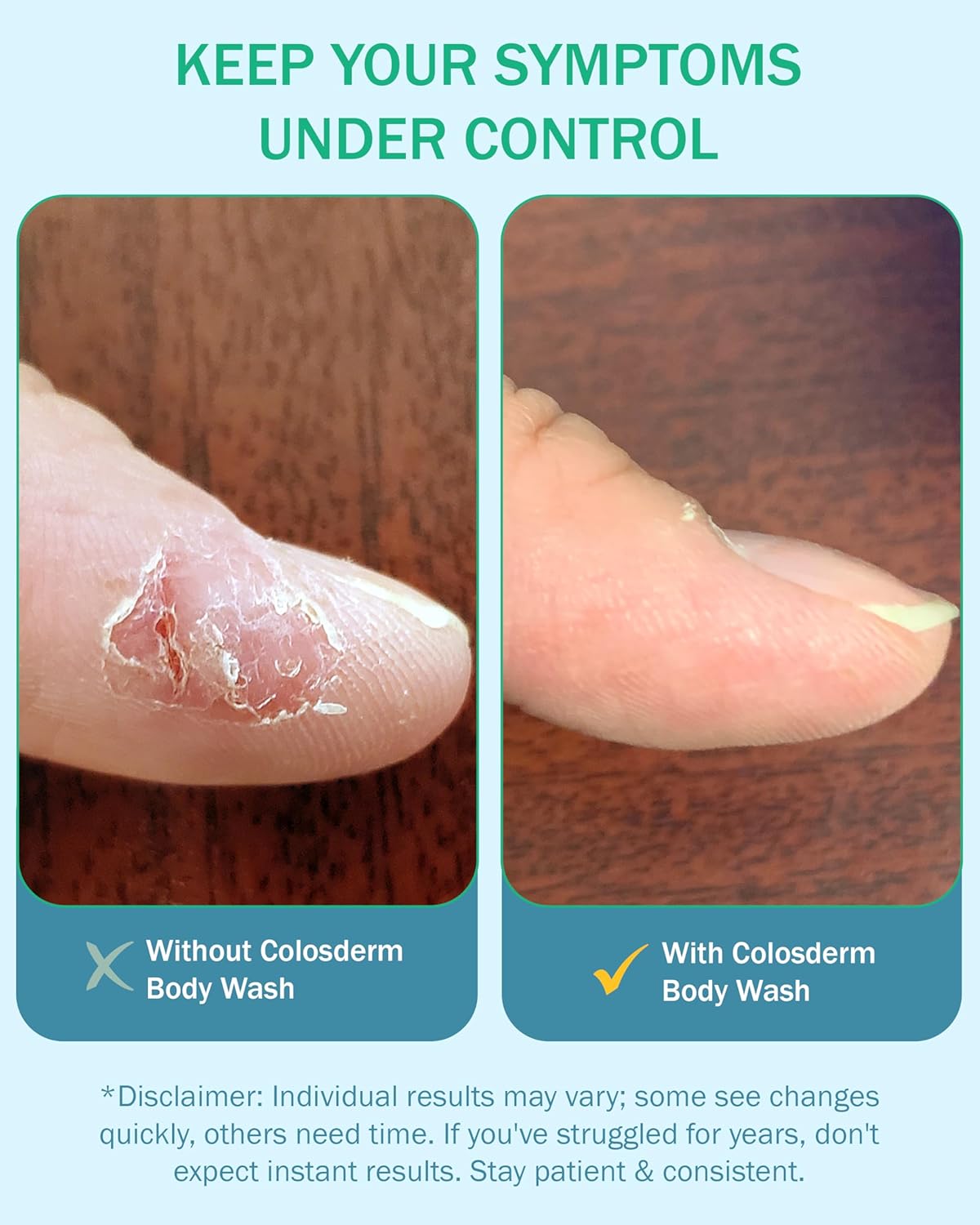 Eczema Cream Body Wash Sensitive Skin for Women & Men - Moisturising Bodywash with Colostrum & Colloidal Oatmeal bath - Gentle Cleanser for Dry Skin, Redness & Irritation, 16 fl oz, Made in USA