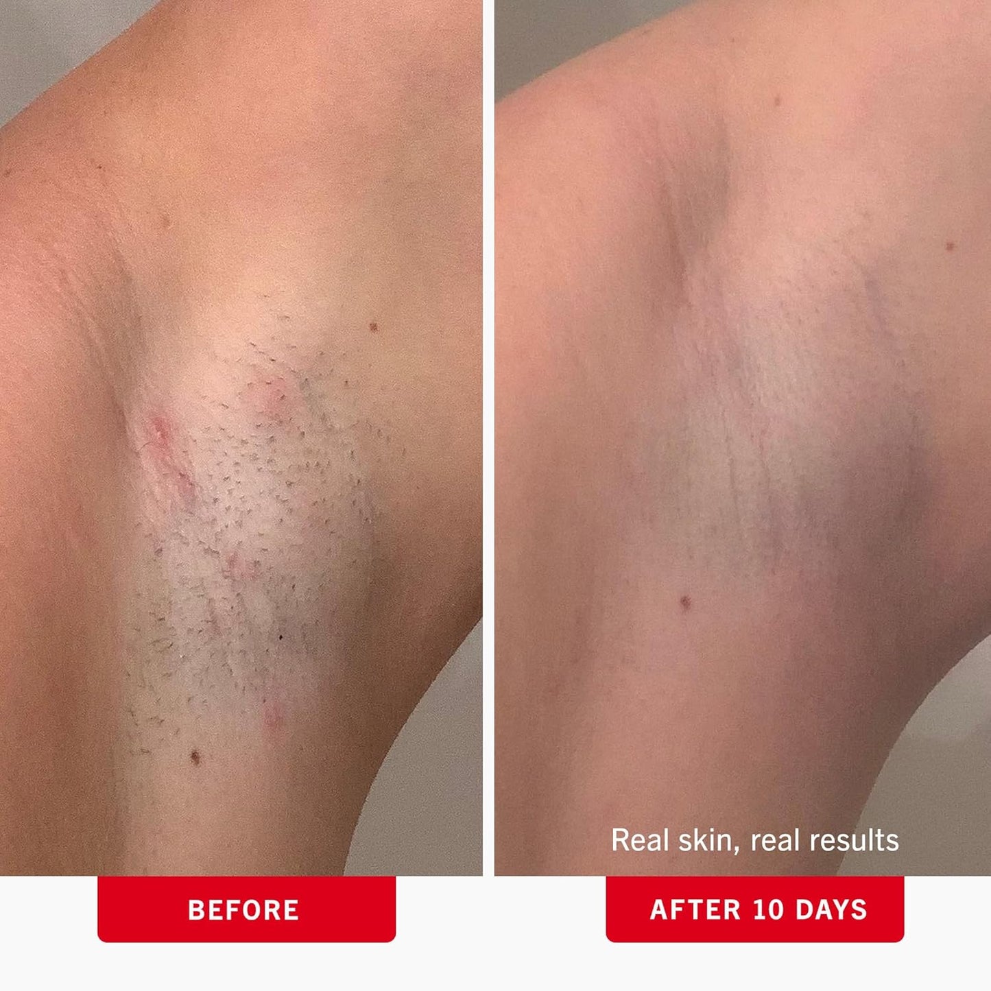 First Aid Beauty - Ingrown Hair Pads with BHA + AHA - Aftershave Treatment Pads to Help Prevent Razor Bumps for Men & Women - Exfoliate Underarms & Bikini Area - Compostable for Daily Use - 28 Pads