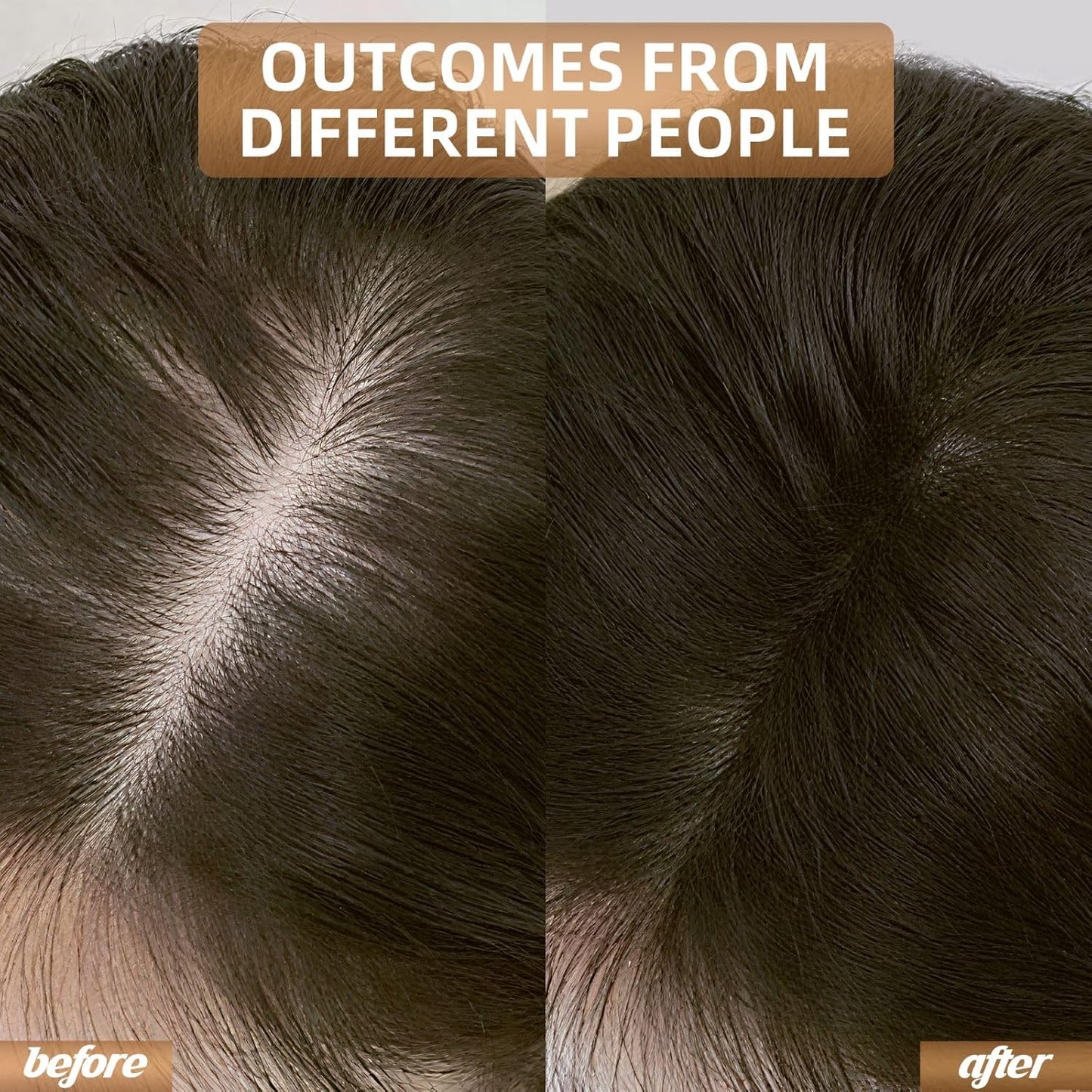 Red Light Therapy for Hair Growth, Laser Hair Loss Treatments Hat, Discreet Daily Use Under Hats, 20-min Rechargeable