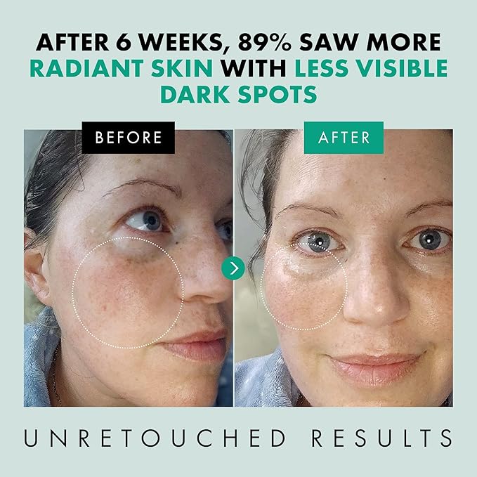 Eclat Skincare Niacinamide Serum - Pore Minimizer for Uneven Complexion - Brightening Niacinamide Serum for Face - Lightening & Moisturizing Skin Care for Dark Spots 1 fl oz