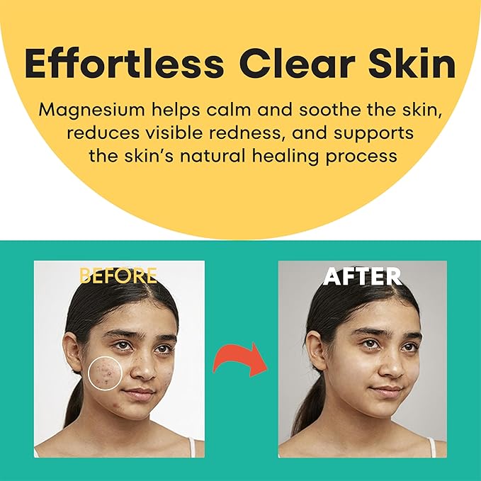 Magneisum Microdart Acne Patch for Early Stage Acnes - Fast Acting Microdart Pimple Patches for face - Zit patches for face