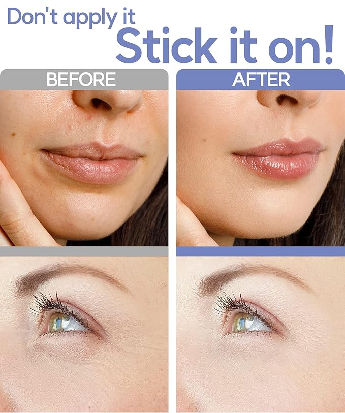 Dissolving Microdart Depuffing Patches for Under Eye and Smile line with Hyaluronic Acid and Tea Tree - 3 pairs - Anti wrinkle patches for face overnight