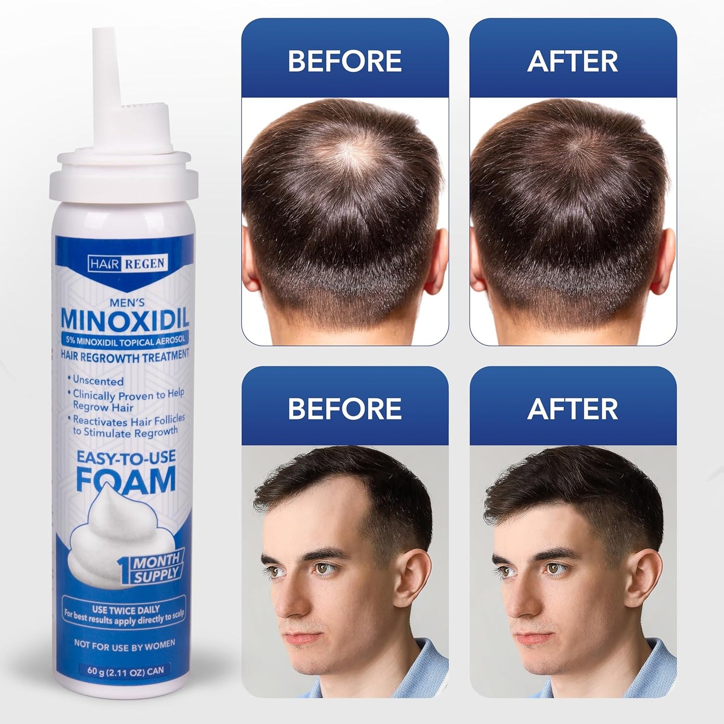 5% Minoxidil Foam for Men 6 Pack - Men's 5 Percent Hair Growth Treatment - Topical Foaming Minoxidil for Men 6 Months Supply - Great for Hair Regrowth and Reduce Hair Loss